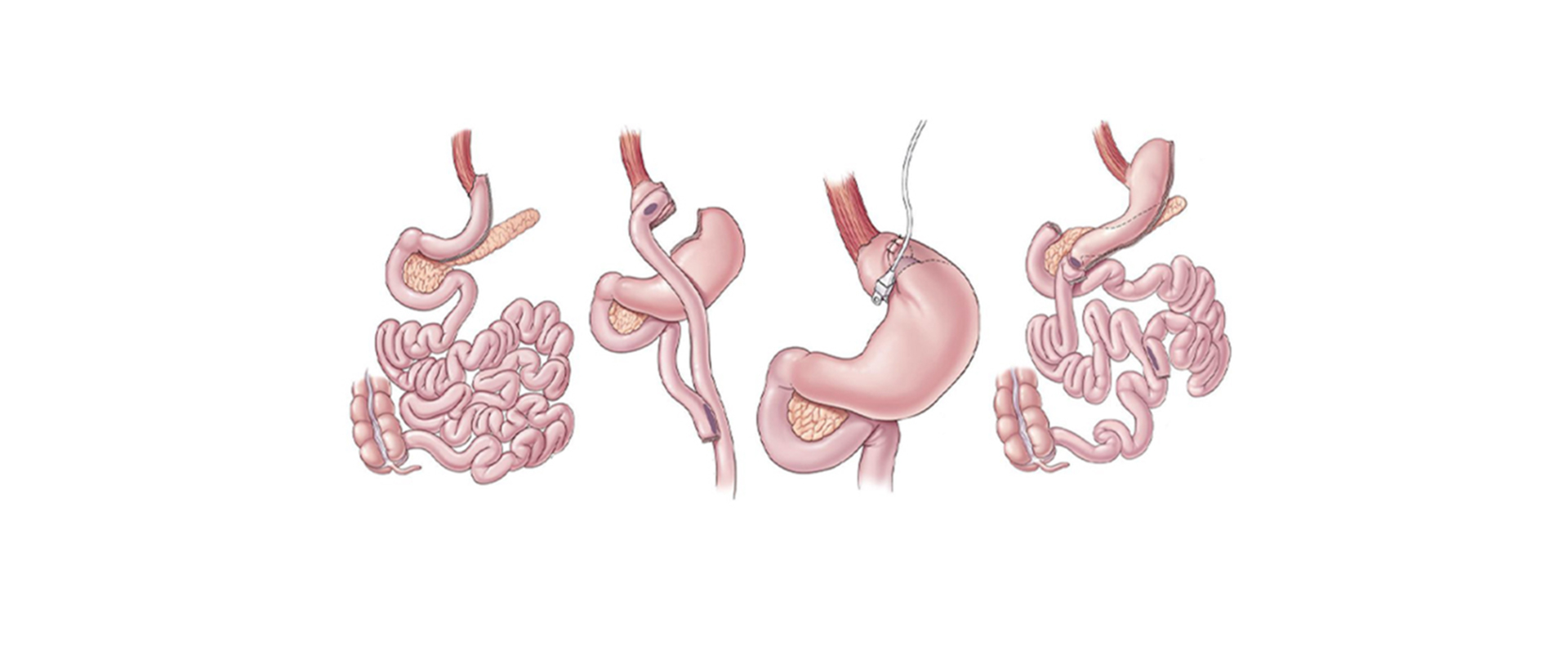 Gastrik Band Revizyonu